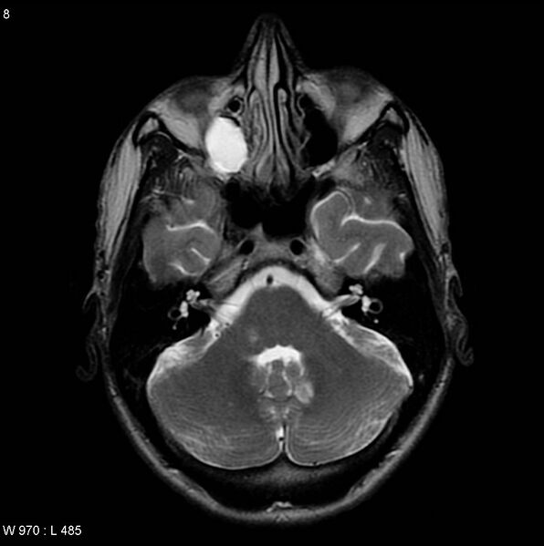File:CMV ventriculitis and encephalitis (Radiopaedia 5416-7166 T2 1).jpg
