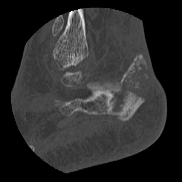File:Calcaneal tuberosity avulsion fracture (Radiopaedia 22649-22668 D 5).jpg