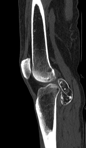 File:Calcified hematoma - popliteal fossa (Radiopaedia 63938-72763 Sagittal bone window 68).jpg