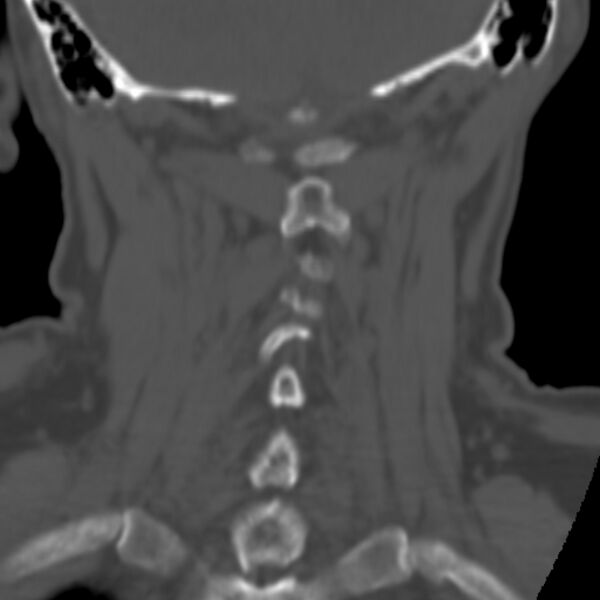 File:Calcified meningioma - cervical canal (Radiopaedia 70136-80171 Coronal bone window 30).jpg