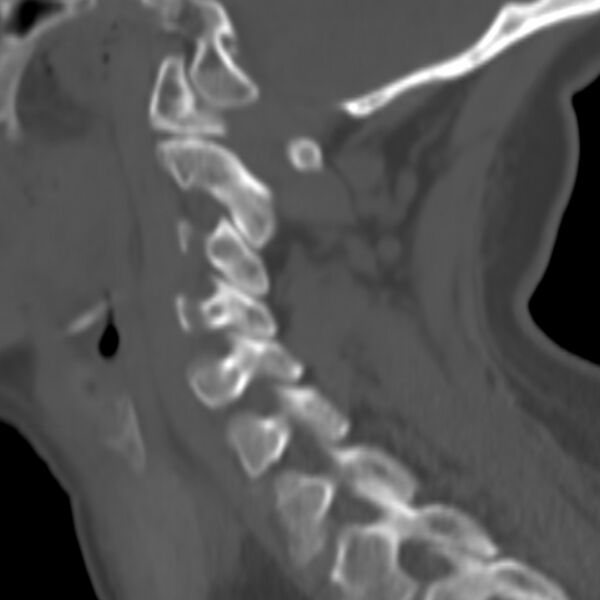 File:Calcified meningioma - cervical canal (Radiopaedia 70136-80171 Sagittal bone window 6).jpg