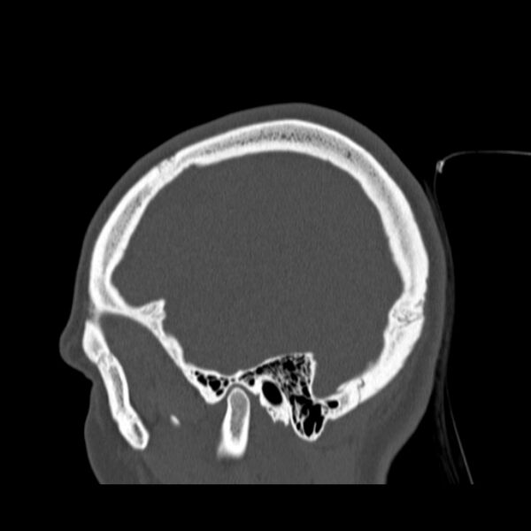 File:Calvarial osteoma (Radiopaedia 36520-38079 Sagittal bone window 89).jpg