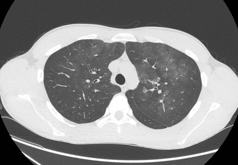 File:Cannabis-induced diffuse alveolar hemorrhage (Radiopaedia 89834-106946 Axial lung window 33).jpg