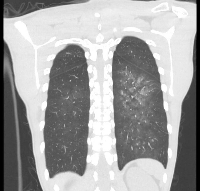 Cannabis-induced diffuse alveolar hemorrhage (Radiopaedia 89834-106946 Coronal lung window 17).jpg