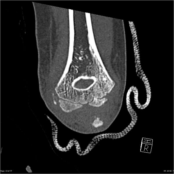 File:Capitellum fracture (Radiopaedia 23352-23426 Coronal bone window 19).jpg
