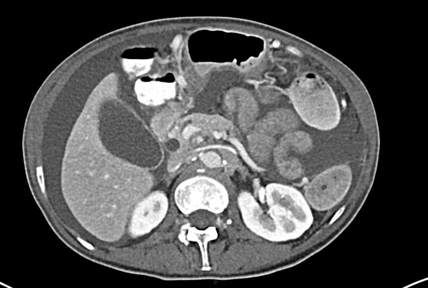 Carcinoid mesenteric tumor complicated by chylous ascites (Radiopaedia 76312-87953 A 25).jpg