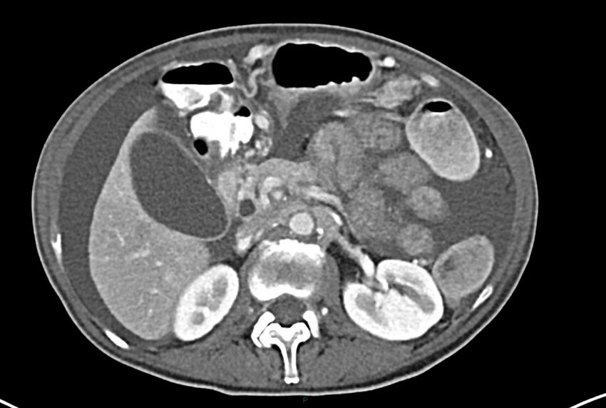 Carcinoid mesenteric tumor complicated by chylous ascites (Radiopaedia 76312-87953 A 26).jpg