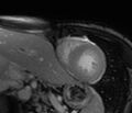 Cardiac amyloidosis (Radiopaedia 39736-42124 F 128).jpg