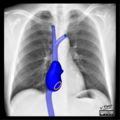 Cardiomediastinal anatomy on chest radiography (annotated images) (Radiopaedia 46331-50742 C 1).png