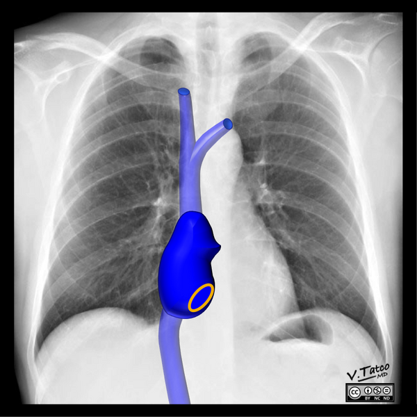 File:Cardiomediastinal anatomy on chest radiography (annotated images) (Radiopaedia 46331-50742 C 1).png