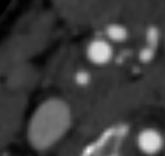 File:Carotid near-occlusion (Radiopaedia 85304-100887 M 82).jpg