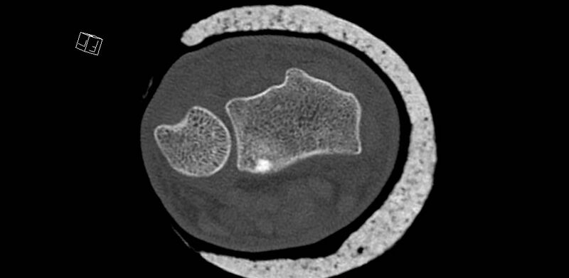 File:Carpal fractures (smart watch impaction) (Radiopaedia 55844-62430 Axial bone window 15).jpg