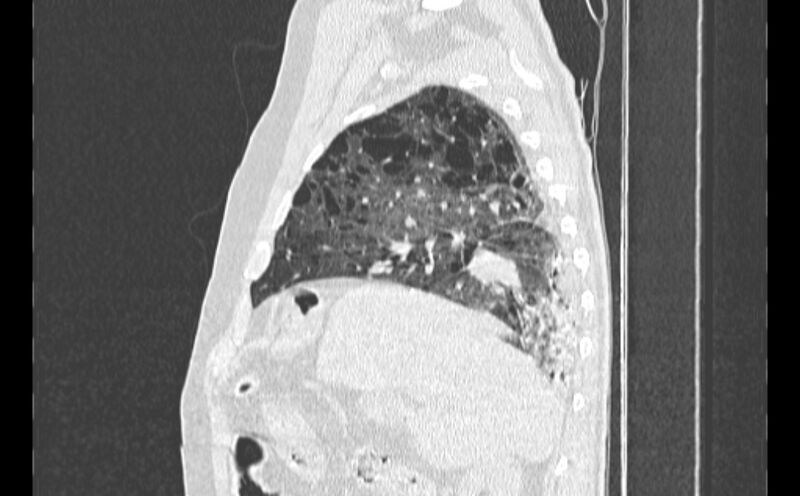 File:Cavitating bronchogenic carcinoma (Radiopaedia 44489-48162 Sagittal lung window 13).jpg