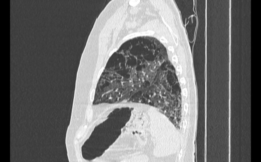 Cavitating bronchogenic carcinoma (Radiopaedia 44489-48162 Sagittal lung window 57).jpg