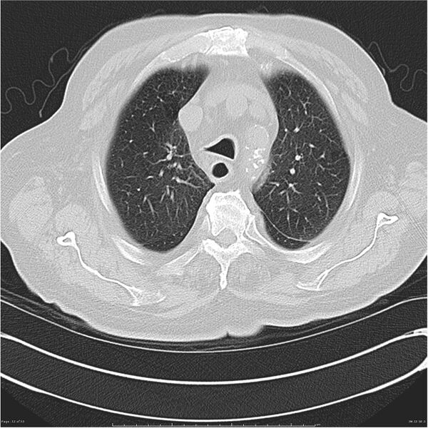 File:Cavitating left lower lobe lesion - squamous cell lung cancer (Radiopaedia 27749-28176 Axial lung window 12).jpg