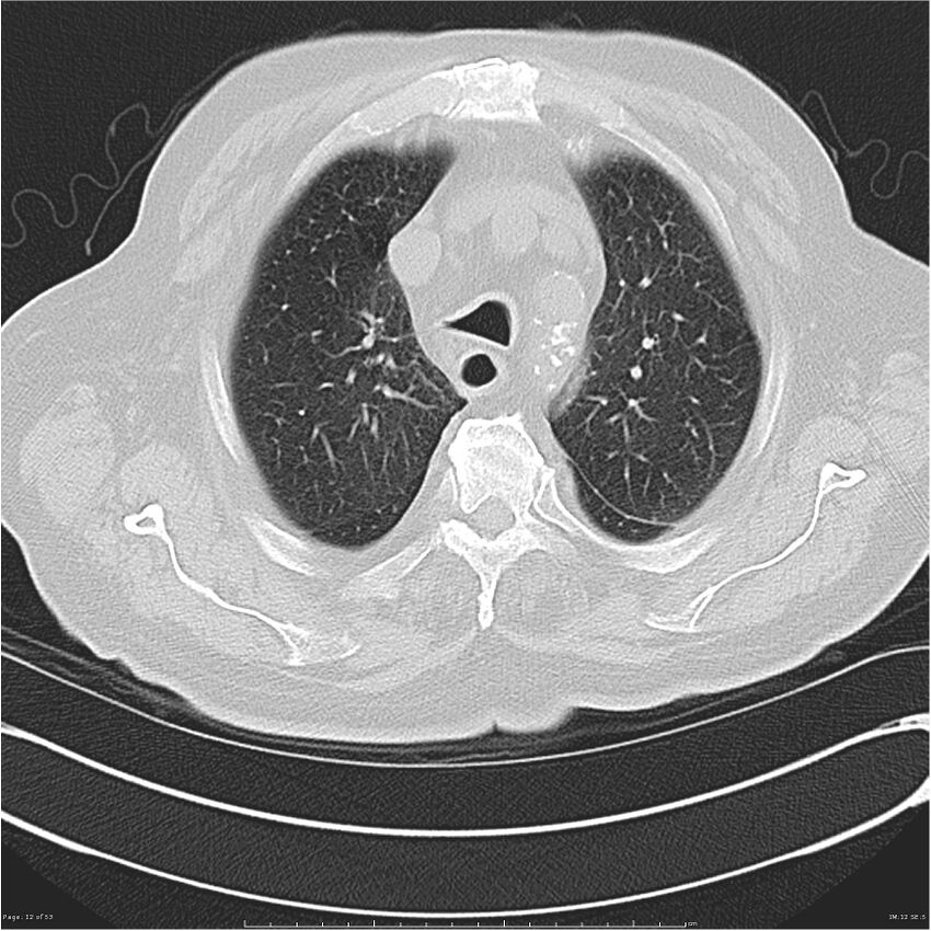 Cavitating left lower lobe lesion - squamous cell lung cancer (Radiopaedia 27749-28176 Axial lung window 12).jpg