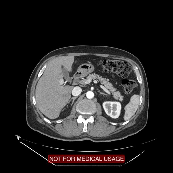 File:Celiac trunk variant anatomy - gastrohepatic trunk and splenic artery (Radiopaedia 38815-40995 A 30).jpg