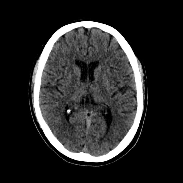 File:Central nervous system Langerhans cell histiocytosis (Radiopaedia 65728-74878 Axial non-contrast 29).jpg