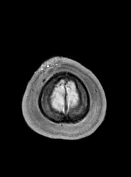 File:Central neurocytoma (Radiopaedia 79320-92381 Axial T1 49).jpg