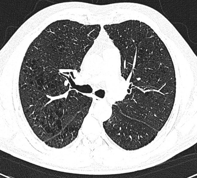 File:Centrilobular pulmonary emphysema (Radiopaedia 26808-26971 Axial lung window 17).jpg