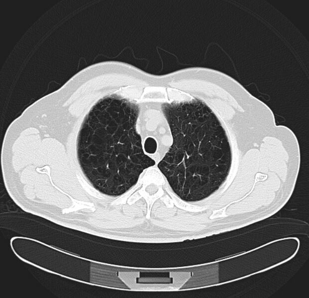 File:Centrilobular pulmonary emphysema (Radiopaedia 26808-26971 C 8).jpg