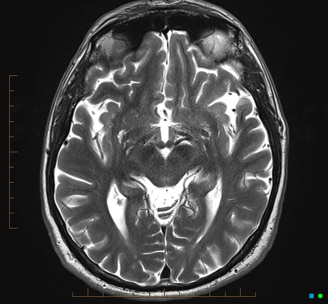 File:Cerebellar gangliocytoma (Radiopaedia 65377-74422 Axial T2 17).jpg