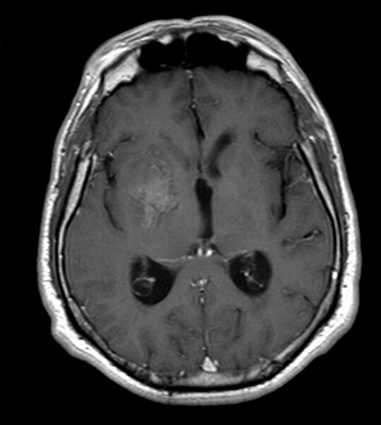 File:Cerebellopontine angle meningioma (Radiopaedia 24459-24764 Axial T1 C+ 13).jpg