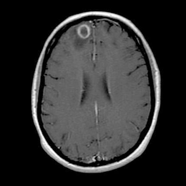 File:Cerebral abscess (Radiopaedia 9975-10538 Axial T1 C+ 1).jpg