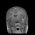 Cerebral abscess post cardiac surgery (Radiopaedia 27244-27420 Coronal T1 C+ 9).jpg
