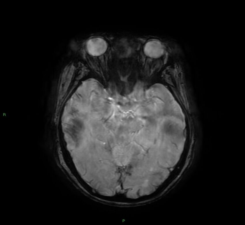 Cerebral amyloid angiopathy-associated lobar intracerebral hemorrhage (Radiopaedia 58378-65517 Axial SWI 28).jpg