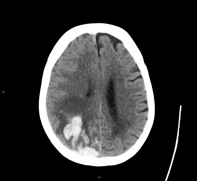 File:Cerebral amyloid angiopathy-associated lobar intracerebral hemorrhage (Radiopaedia 58563-65727 Axial non-contrast 21).jpg
