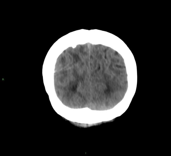File:Cerebral amyloid angiopathy-associated lobar intracerebral hemorrhage (Radiopaedia 58566-65730 Coronal non-contrast 14).jpg