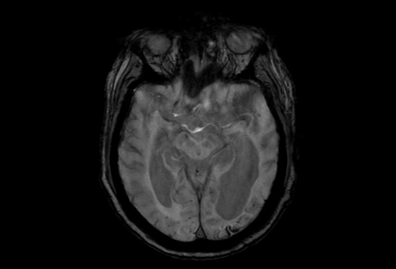 File:Cerebral amyloid angiopathy (Radiopaedia 86671-102792 Axial Gradient Echo 33).jpg