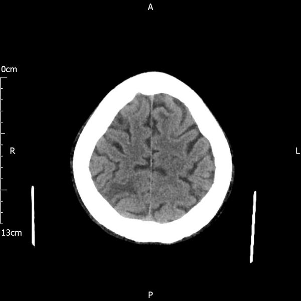 File:Cerebral amyloid angiopathy related inflammation (Radiopaedia 72772-83480 Axial non-contrast 23).jpg