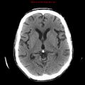 Cerebral and orbital tuberculomas (Radiopaedia 13308-13310 Axial non-contrast 14).jpg