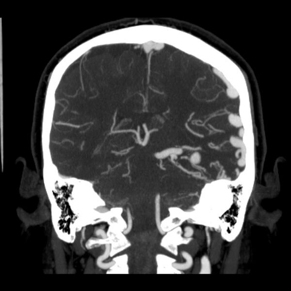 File:Cerebral arteriovenous malformation (Radiopaedia 43729-47189 C 30).jpg