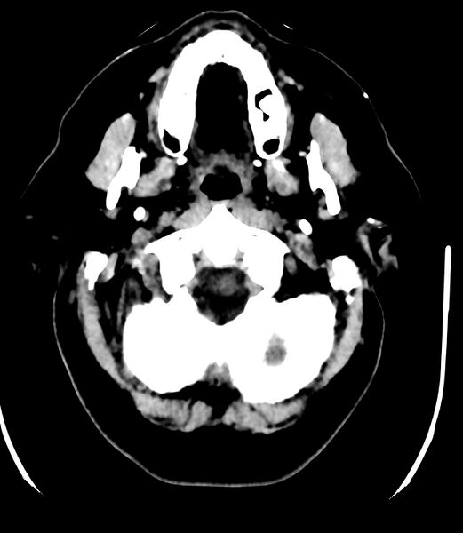 File:Cerebral dural venous sinus thrombosis (Radiopaedia 86514-102575 Axial non-contrast 4).jpg