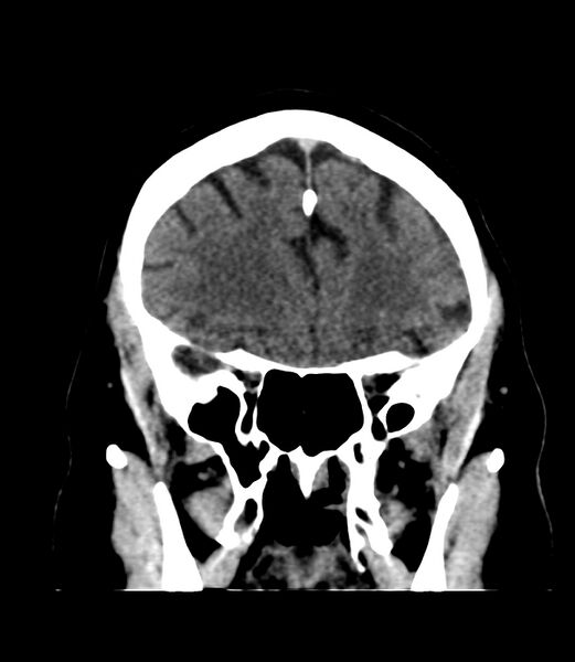 File:Cerebral dural venous sinus thrombosis (Radiopaedia 86514-102575 Coronal non-contrast 11).jpg