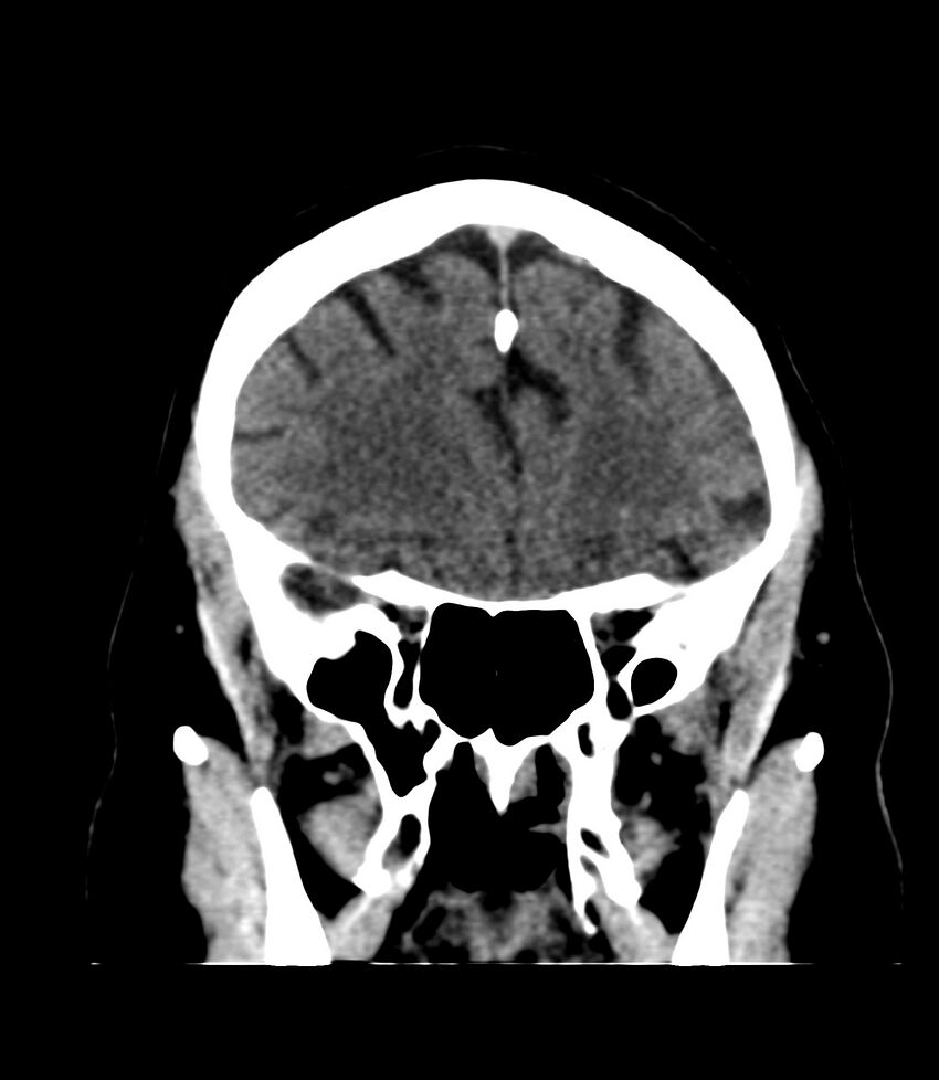 Cerebral dural venous sinus thrombosis (Radiopaedia 86514-102575 Coronal non-contrast 11).jpg