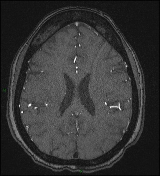 File:Cerebral fat embolism (Radiopaedia 35022-36525 Axial TOF 133).jpg