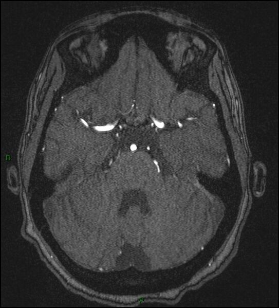 File:Cerebral fat embolism (Radiopaedia 35022-36525 Axial TOF 62).jpg
