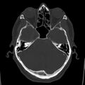 Cerebral hemorrhagic contusions (Radiopaedia 23145-23188 Axial bone window 15).jpg