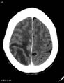 Cerebral metastasis - lung cancer (Radiopaedia 5315-7072 Axial C+ delayed 10).jpg