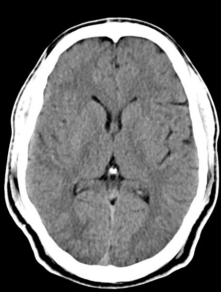 File:Cerebral venous angioma (Radiopaedia 69959-79977 Axial non-contrast 17).jpg