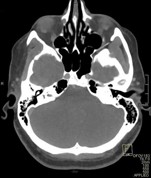 File:Cerebral venous sinus thrombosis (Radiopaedia 91329-108965 Axial venogram 22).jpg