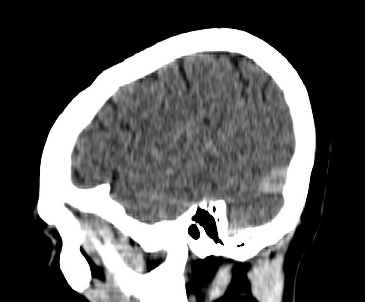 File:Cerebral venous thrombosis - CT only (Radiopaedia 41031-43778 B 38).jpg