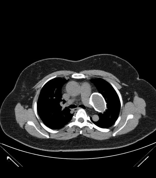 File:Cervical aortic arch with coarctation and aneurysms (Radiopaedia 44035-47552 Axial non-contrast 20).jpg