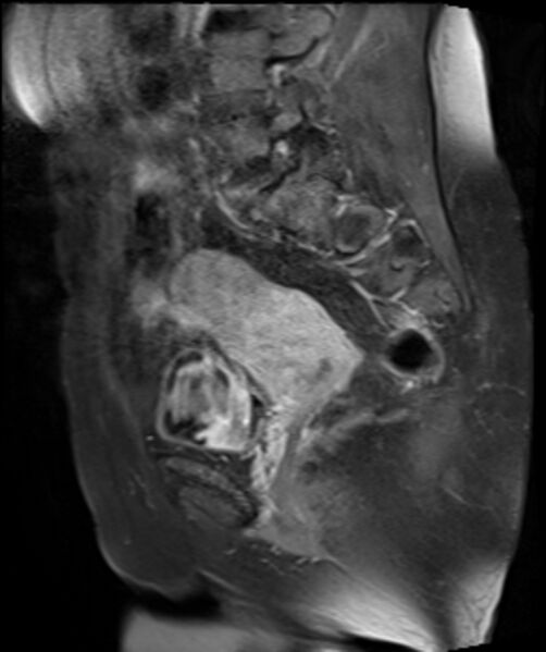 File:Cervical carcinoma (Radiopaedia 88312-104943 E 18).jpg