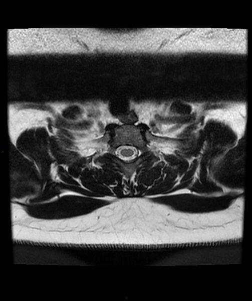 File:Cervical disc prolapse (Radiopaedia 80258-93598 Axial T2 83).jpg