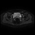 Cesarian section scar endometriosis (Radiopaedia 66520-75799 Axial DWI 42).jpg